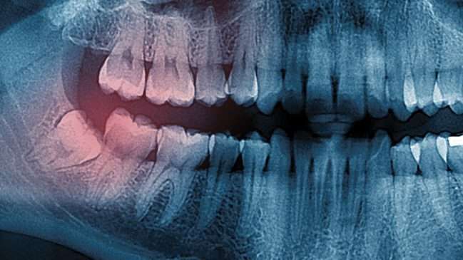 Wisdom Teeth